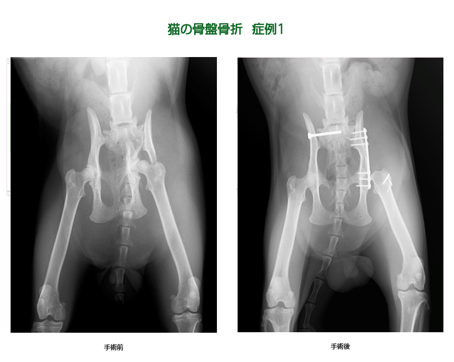 骨盤骨折