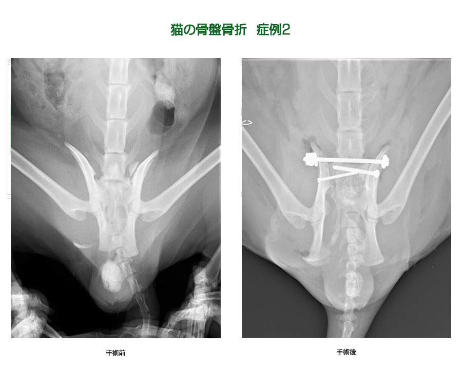 骨盤骨折